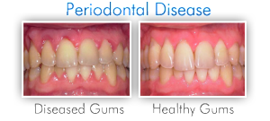 Gum-Disease