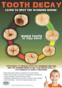 progression of tooth decay